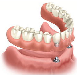 имплантации для протезирования зубов